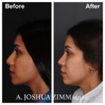 Rhinoplasty - before and after