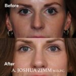 Rhinoplasty - before and after