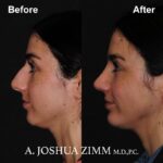 Chin implant - before and after