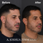 Chin implant - before and after