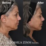 Facelift - before and after