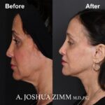 Facelift - before and after