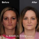 Rhinoplasty - before and after