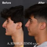 Rhinoplasty - before and after