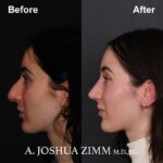 Rhinoplasty - before and after