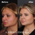 Rhinoplasty - before and after