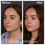 Rhinoplasty - before and after