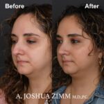 Rhinoplasty - before and after