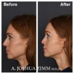 Rhinoplasty - before and after