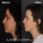 Rhinoplasty - before and after