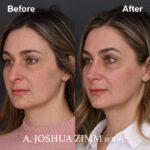 Rhinoplasty - before and after