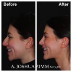 Rhinoplasty - before and after