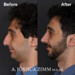 Rhinoplasty - before and after