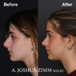 Rhinoplasty - before and after