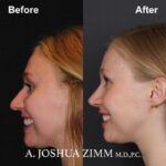 Rhinoplasty - before and after