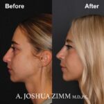 Rhinoplasty - before and after