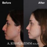 Rhinoplasty - before and after