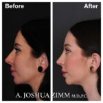 Rhinoplasty - before and after