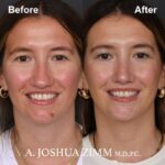 Rhinoplasty - before and after