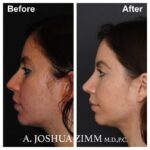 Rhinoplasty - before and after