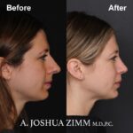 Rhinoplasty - before and after