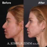 Rhinoplasty - before and after