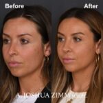 Rhinoplasty - before and after