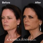 Rhinoplasty - before and after