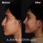 Rhinoplasty - before and after