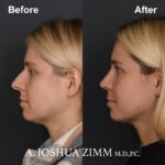 Rhinoplasty - before and after