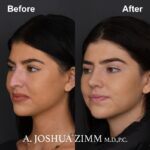 Rhinoplasty - before and after