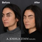 Rhinoplasty - before and after