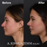 Rhinoplasty - before and after