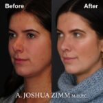 Rhinoplasty - before and after