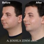 Rhinoplasty - before and after