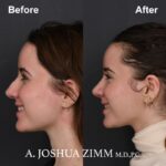 Rhinoplasty - before and after