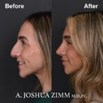 Rhinoplasty - before and after