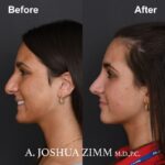 Rhinoplasty - before and after