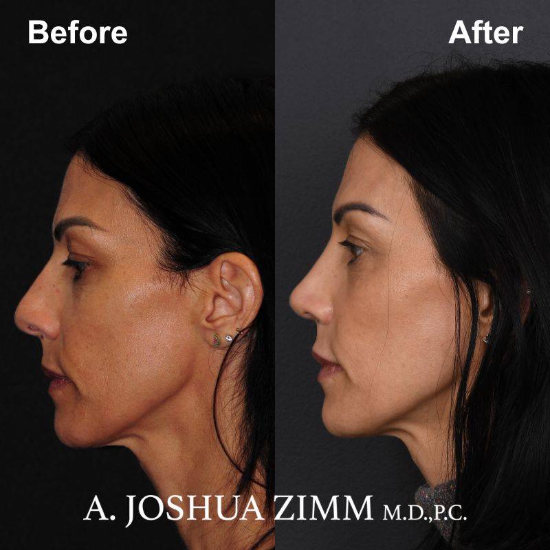 Rhinoplasty - before and after