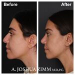 Rhinoplasty - before and after