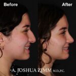 Rhinoplasty - before and after