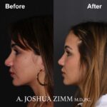 Rhinoplasty - before and after