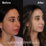 Rhinoplasty - before and after