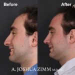 Rhinoplasty - before and after