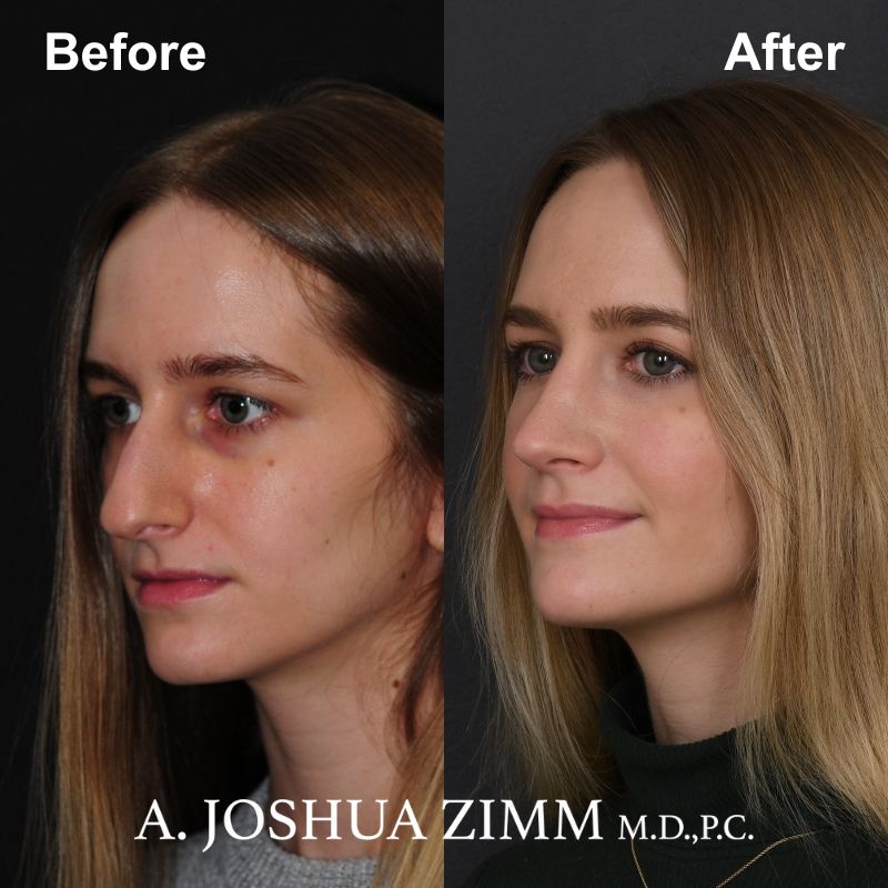 Rhinoplasty - before and after