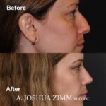 Rhinoplasty - before and after