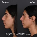 Rhinoplasty - before and after