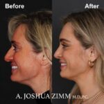 Rhinoplasty - before and after