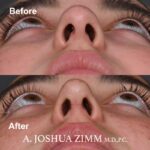 Rhinoplasty - before and after