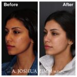 Rhinoplasty - before and after